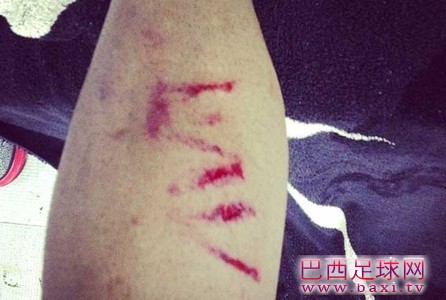 阿尔维斯曝光腿部受伤照片